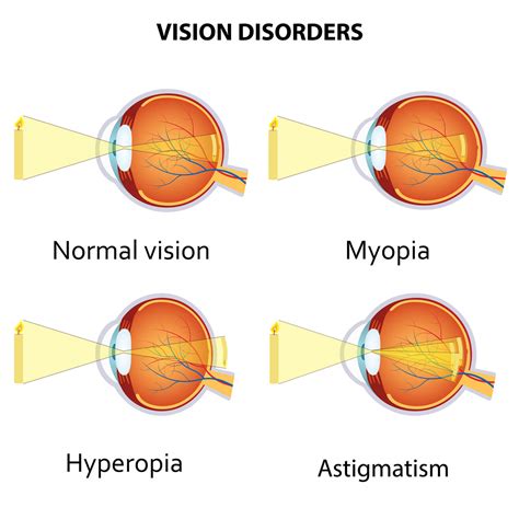 myopia hyperopia diagrams 